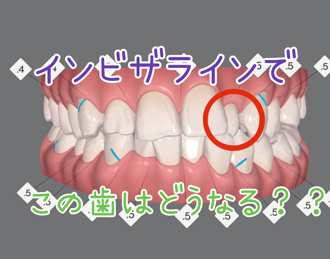 インビザラインとは 意外と早く歯が動いて痛くないんです 歯並びブログ 広島・ナタリーデンタルクリニック