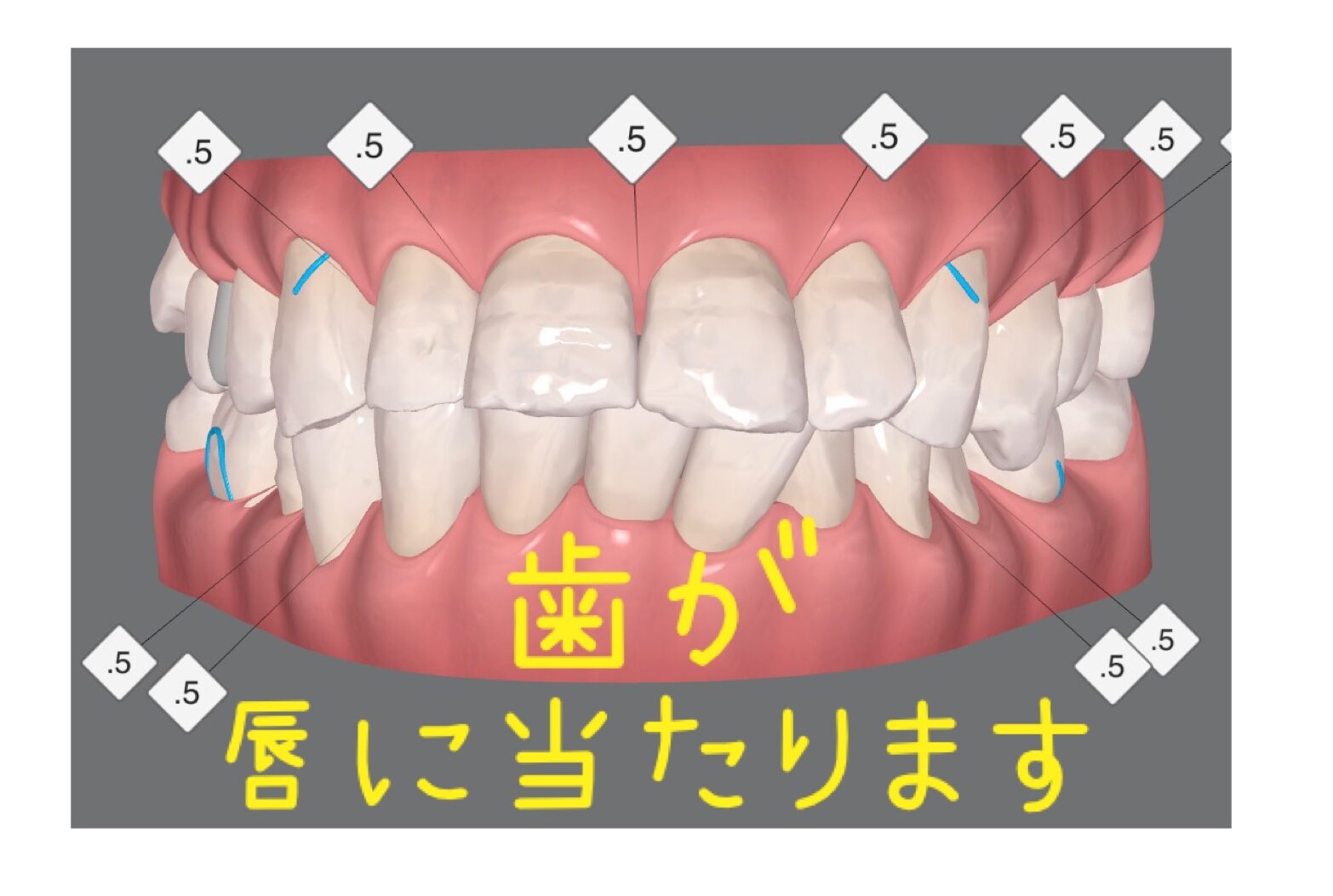 口端が切れる _ 口の中 切れる 原因 – WQHUET