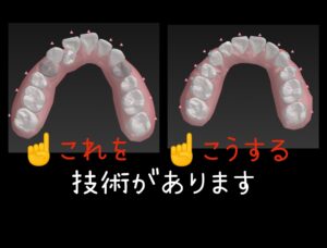 インビザラインとクリアコレクトの違い 叢生を抜歯ケースで矯正の場合 お口の再生博士のサムネイル画像