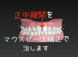 正中離開で受け口はゴムかけして非抜歯でインビザラインのジェネリック　クリアコレクトで矯正　お口の再生博士のサムネイル画像