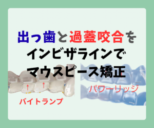 でっ歯　過蓋咬合の抜歯ケースをインビザラインはゴム掛けが必要　お口の再生博士のサムネイル画像