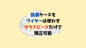 口ゴボと叢生をインビザラインのジェネリック　クリアコレクトで抜歯して矯正　お口の再生博士のサムネイル画像