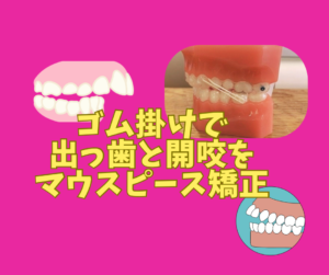 出っ歯　開咬をインビザラインのジェネリック　クリアコレクトで矯正しました　ゴム掛けはⅡ級ゴム　お口の再生博士のサムネイル画像