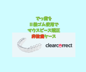 でっ歯をクリアコレクトで矯正は抜歯と非抜歯で計画を創って下さいその2　お口の再生博士のサムネイル画像