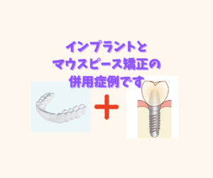インプラントとインビザラインのジェネリック　クリアコレクトの併用ケース　お口の再生博士のサムネイル画像