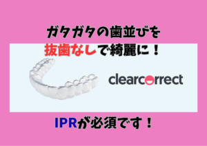 叢生をインビザラインのジェネリック　クリアコレクトで非抜歯矯正しましたのサムネイル画像