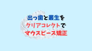 でっ歯と叢生をインビザラインのジェネリック　クリアコレクトで矯正のサムネイル画像