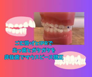 でっ歯　叢生を非抜歯Ⅱ級ゴムでインビザラインのジェネリッククリアコレクトで矯正　お口の再生博士のサムネイル画像