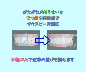 叢生で正中の不一致をマウスピース矯正のクリアコレクトで矯正   お口の再生博士のサムネイル画像