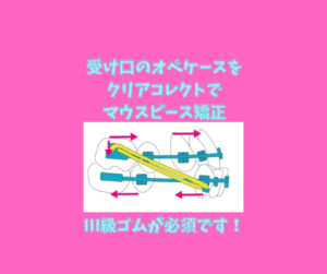 受け口のオペケースをマウスピース矯正のクリアコレクトで矯正お口の再生博士のサムネイル画像