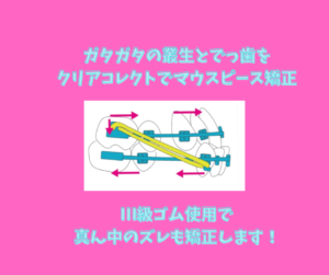 でっ歯と叢生をインビザラインのジェネリック　クリアコレクトで矯正　お口の再生博士のサムネイル画像