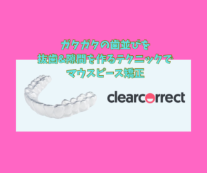 叢生抜歯ケースをマウスピース矯正のクリアコレクトで矯正しました　お口の再生博士のサムネイル画像