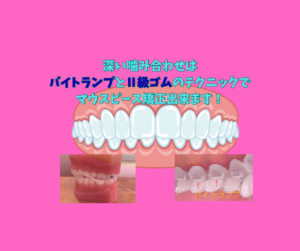 過蓋咬合をマウスピース矯正で　ゴム掛けとバイトランプが有効　お口の再生博士のサムネイル画像