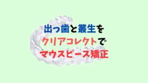 出っ歯と叢生をⅡ級ゴムを使いマウスピース矯正のクリアコレクトで矯正しました　お口の再生博士のサムネイル画像