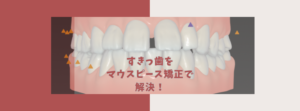 上顎前突　正中離開をゴムかけしてマウスピース矯正で矯正　お口の再生博士のサムネイル画像