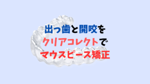 過去に二回ワイヤー矯正後　後戻りで開咬をマウスピース矯正で治療 お口の再生博士のサムネイル画像