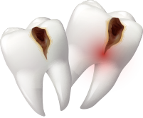 虫歯になった歯