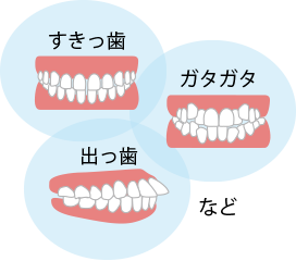 悪い歯並びの影響 見た目の悪さ 虫歯リスクの原因など 広島のマウスピース矯正 ナタリーデンタルクリニック