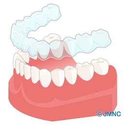 矯正用マウスピースのイラスト
