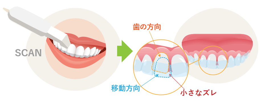 図解:口腔内スキャナーで分析・マウスピース矯正装置による歯の移動方向解説