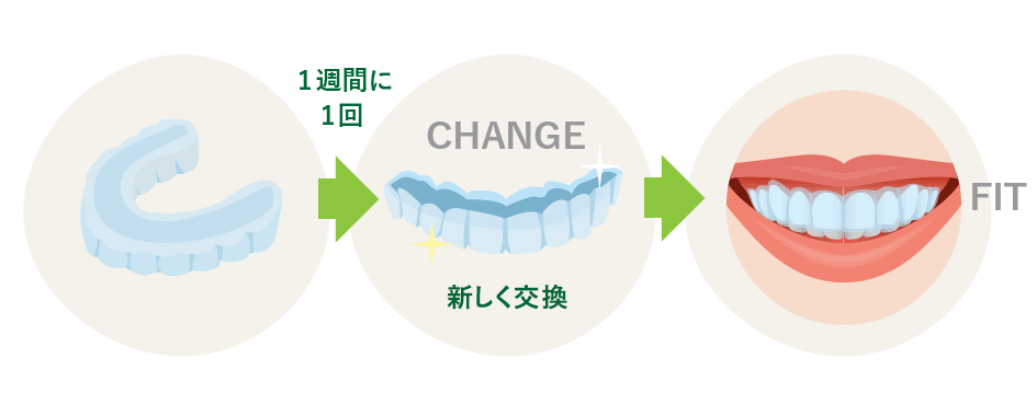図解:マウスピースの交換頻度と装着したイメージ