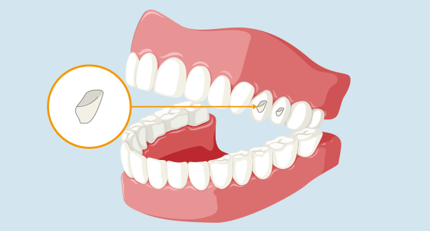 マウスピース矯正とは 歯並びを治す仕組み 広島 ナタリーデンタルクリニック