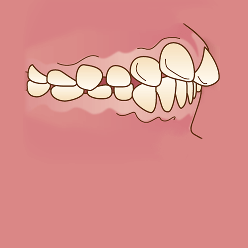 矯正治療が必要な歯並び 不正咬合の種類 広島ナタリーデンタルクリニック マウスピース矯正サイト