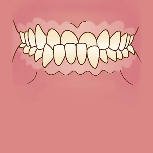 矯正治療が必要な歯並び 不正咬合の種類 広島ナタリーデンタルクリニック マウスピース矯正サイト