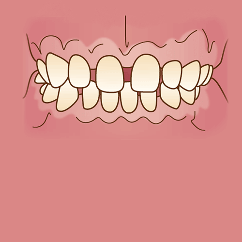 矯正治療が必要な歯並び 不正咬合の種類 広島ナタリーデンタルクリニック マウスピース矯正サイト