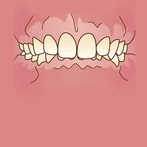 矯正治療が必要な歯並び 不正咬合の種類 広島ナタリーデンタルクリニック マウスピース矯正サイト