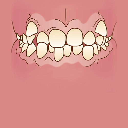 矯正治療が必要な歯並び 不正咬合の種類 広島ナタリーデンタルクリニック マウスピース矯正サイト