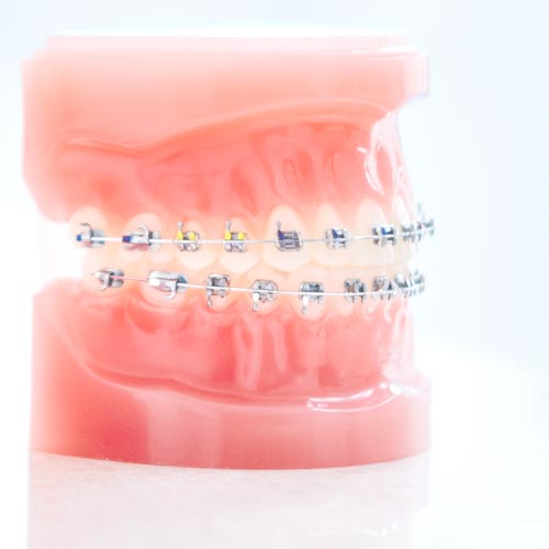マルチブラケット矯正装置模型