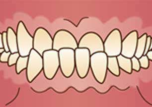 イラスト図：受け口(反対咬合)