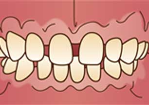 イラスト図：すきっ歯(空隙歯列)