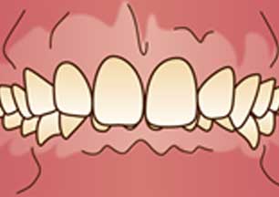 イラスト図：噛み合わせが深い(過蓋咬合)