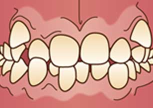 イラスト図：デコボコな歯列(叢生)